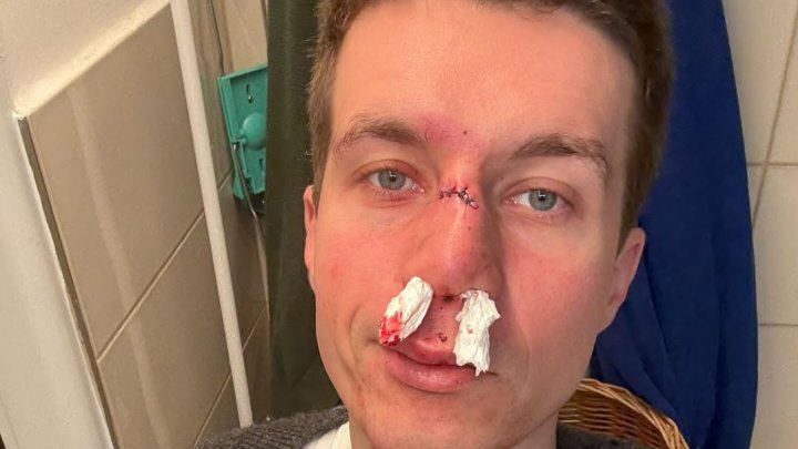 Daniel Krejčík si ublížil na ledovce. 